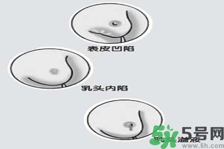 乳頭內(nèi)陷怎么矯正？乳頭內(nèi)陷矯正方法是什么？