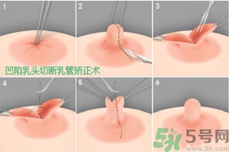 乳頭內(nèi)陷怎么矯正？乳頭內(nèi)陷矯正方法是什么？