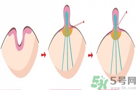 乳頭內(nèi)陷矯正需注意什么？乳頭內(nèi)陷如何預(yù)防？