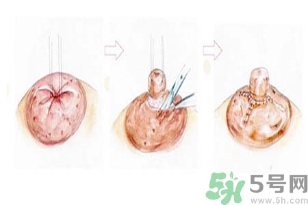 乳頭內(nèi)陷矯正需注意什么？乳頭內(nèi)陷如何預(yù)防？