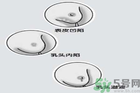 乳頭內(nèi)陷矯正需注意什么？乳頭內(nèi)陷如何預(yù)防？