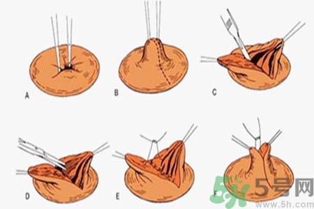 乳頭內(nèi)陷能不能喂奶？乳頭凹陷怎樣哺乳？