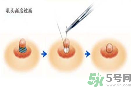 乳頭內(nèi)陷能不能喂奶？乳頭凹陷怎樣哺乳？