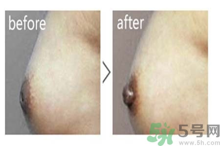 乳頭內(nèi)陷可以用吸奶器嗎？乳頭內(nèi)陷能不能用吸奶器？