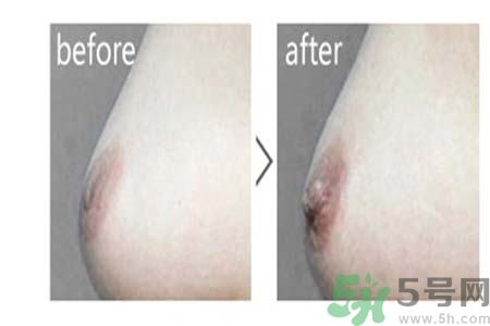 乳頭內陷可以拔罐嗎？乳頭內陷需要手術治療嗎？