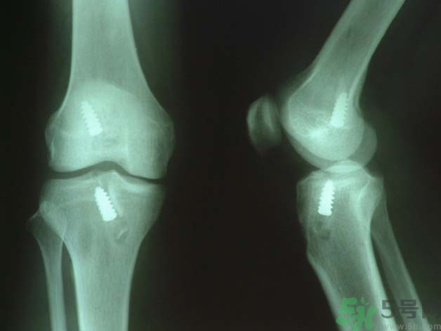 韌帶斷裂吃什么好得快？前十字韌帶斷裂吃什么補品？