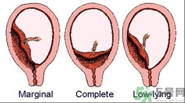 陰道出血是怎么回事？如何預防陰道出血？