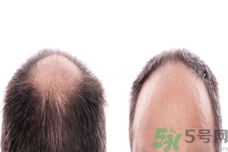 頭發(fā)稀少的原因是什么？如何預(yù)防禿頂?shù)陌l(fā)生？