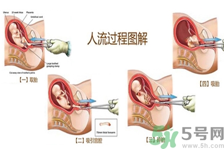 人工流產(chǎn)后多久可以再次懷孕？流產(chǎn)后需要注意什么？