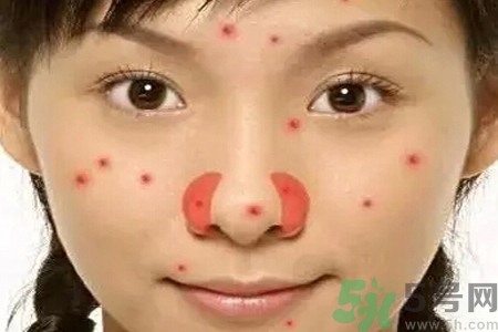 鼻翼長痘痘怎么回事？鼻翼長痘痘的原因是什么？