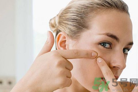 鼻子兩側(cè)長痘的原因是什么？如何去除鼻子兩側(cè)的痘？