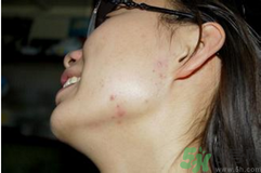 腮幫子長痘痘是什么原因？腮幫子長痘痘怎么調理？