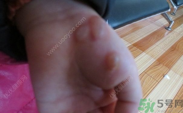 15歲還會(huì)得手足口病嗎？手足口病的癥狀有哪些？