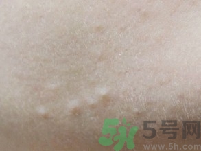 什么原因?qū)е路鄞?導(dǎo)致黑頭粉刺特殊原因介紹 什么原因?qū)е路鄞?導(dǎo)致黑頭粉刺特殊原因介紹