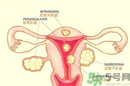 ?子宮移位怎么治療？子宮移位能懷孕嗎？