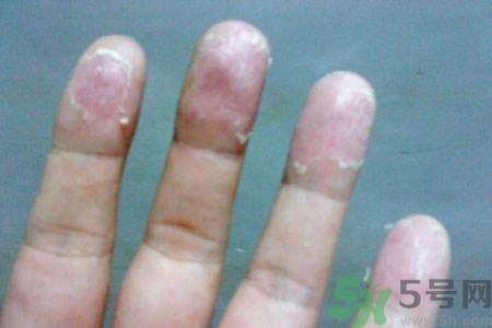 ?手掌脫皮的危害有哪些？如何預(yù)防手掌脫皮？