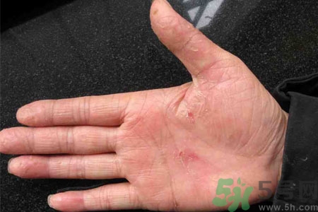 ?手掌脫皮的危害有哪些？如何預(yù)防手掌脫皮？
