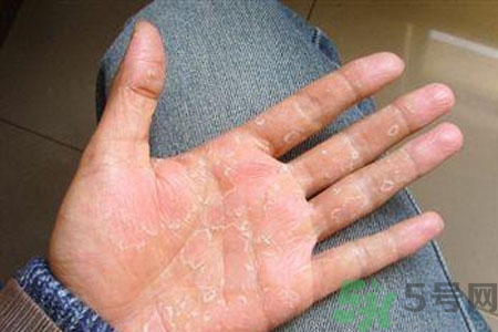 ?手掌脫皮的危害有哪些？如何預(yù)防手掌脫皮？
