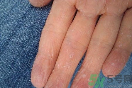 ?手掌脫皮的危害有哪些？如何預(yù)防手掌脫皮？