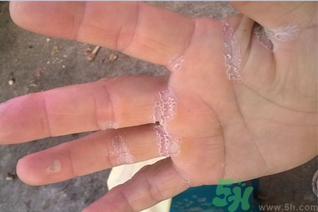 ?手掌脫皮的危害有哪些？如何預(yù)防手掌脫皮？