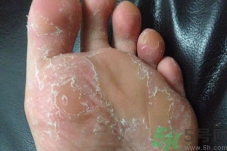 腳脫皮的治療方法有哪些？如何預(yù)防腳脫皮？