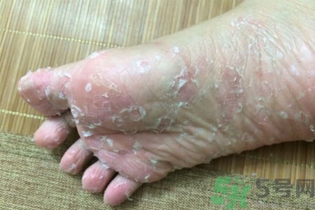 腳脫皮的治療方法有哪些？如何預(yù)防腳脫皮？