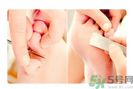 雞眼如何去除？腳上長了雞眼怎么治療？