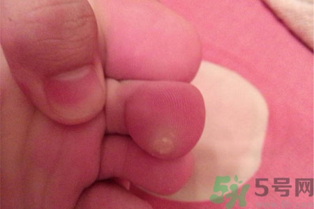 雞眼如何去除？腳上長了雞眼怎么治療？