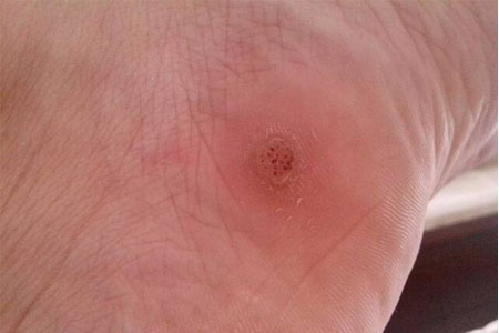雞眼如何去除？腳上長了雞眼怎么治療？