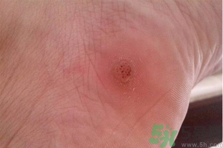 腳上長(zhǎng)雞眼是怎么回事？腳上長(zhǎng)雞眼是怎么辦？