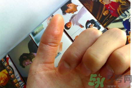 腳上長雞眼是怎么回事？腳上長雞眼是怎么辦？