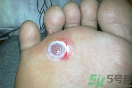 腳上長(zhǎng)雞眼是怎么回事？腳上長(zhǎng)雞眼是怎么辦？