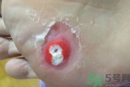 雞眼怎么能徹底根治？如何預防腳上長雞眼？