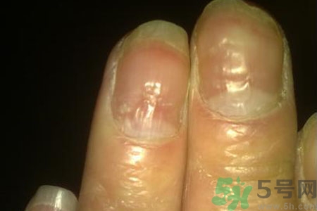 孩子手指甲凹凸不平是什么原因？手指甲凹凸不平的原因是什么？