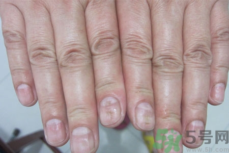 孩子手指甲凹凸不平是什么原因？手指甲凹凸不平的原因是什么？