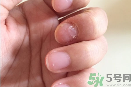 孩子手指甲凹凸不平是什么原因？手指甲凹凸不平的原因是什么？