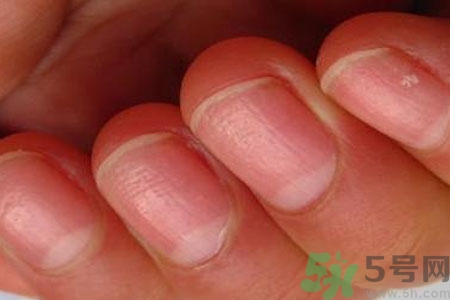 手指甲凹凸不平是怎么回事？如何預(yù)防手指甲凹凸不平？
