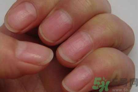 手指甲凹凸不平是怎么回事？如何預(yù)防手指甲凹凸不平？