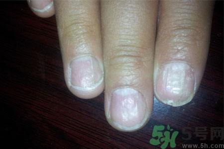 手指甲凹凸不平是怎么回事？如何預(yù)防手指甲凹凸不平？