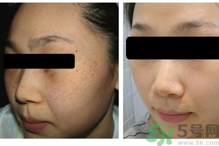 激光縮毛孔多少錢(qián)一次？激光縮毛孔一個(gè)療程多少錢(qián)？