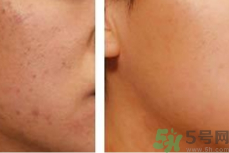 毛孔粗大的原因是什么？激光可以改善毛孔粗大嗎？