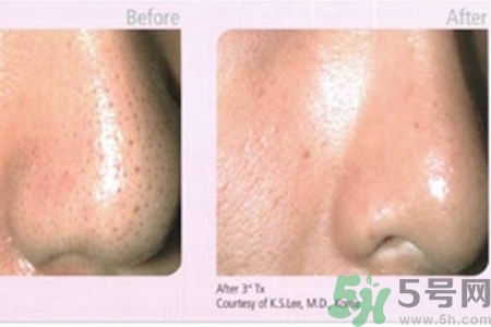 毛孔粗大的原因是什么？激光可以改善毛孔粗大嗎？