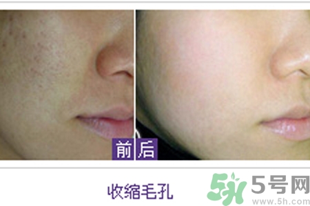 毛孔粗大的原因是什么？激光可以改善毛孔粗大嗎？