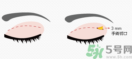 提眉術(shù)后多久可以恢復(fù)？提眉術(shù)后全過程照片