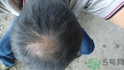 斑禿是什么原因造成的?斑禿飲食注意什么 斑禿是什么原因造成的?斑禿飲食注意什么