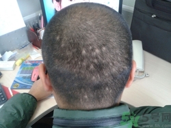 斑禿是什么原因造成的?斑禿飲食注意什么 斑禿是什么原因造成的?斑禿飲食注意什么