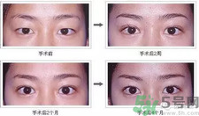 提眉術(shù)后多久可以恢復(fù)？提眉術(shù)后全過程照片