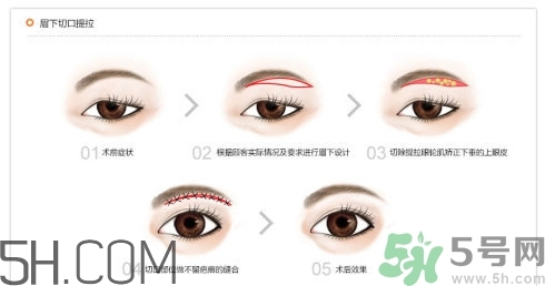 切眉手術(shù)后老得快嗎？切眉能保持多久？