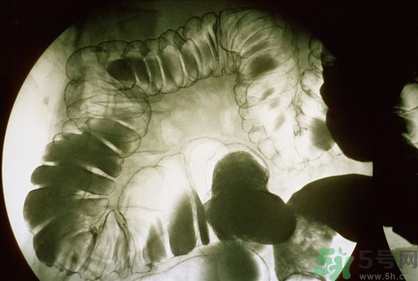 腸炎肚子疼怎么辦？腸炎肚子疼怎么緩解？