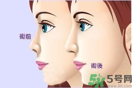 玻尿酸隆鼻的缺點(diǎn)是什么？玻尿酸隆鼻的優(yōu)點(diǎn)有哪些？